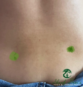 Kết quả điều trị cột sống 12
