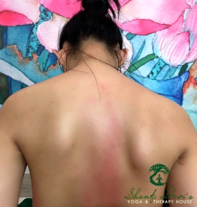Kết quả điều trị cột sống 17