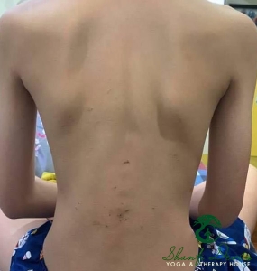 Kết quả điều trị cột sống 20