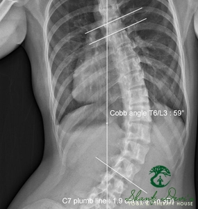 Kết quả điều trị cột sống 3