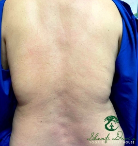 Kết quả điều trị cột sống 5