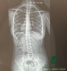 Kết quả điều trị cột sống 1